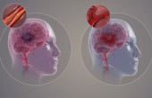 Phân loại bệnh mạch máu não và triệu chứng nhận biết sớm nhất
