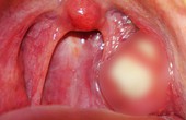 Hạt trắng trong miệng là bệnh gì? 