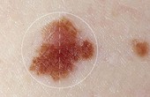 Nhận biết chính xác dấu hiệu ung thư da dựa vào sự bất thường của nốt ruồi