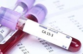 Tìm hiểu phương pháp xét nghiệm ung thư vú CA 15-3