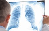 Viêm nấm phổi: Nguyên nhân và cách điều trị