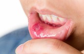 Bệnh nhiệt miệng là gì? Những thông tin cần biết về bệnh nhiệt miệng