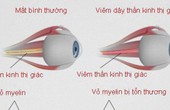  Viêm dây thần kinh thị giác là gì?