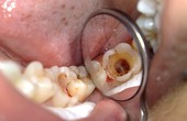 Nguyên nhân viêm tuỷ răng nhiều người không ngờ tới