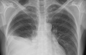 Cách siêu âm và chẩn đoán tràn dịch màng phổi