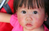 Dị ứng đậu phộng ở trẻ nhỏ: Nắm chính xác những triệu chứng này để cứu con kịp thời
