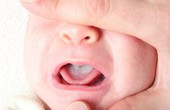 Nguyên nhân và cách xử trí tình trạng tưa lưỡi ở trẻ em