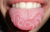 Những điều cần biết về bệnh viêm lưỡi di trú