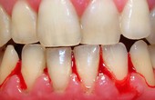 Chảy máu chân răng: Hiện tượng không thể thờ ơ