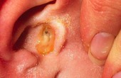 Cần phát hiện sớm bệnh viêm tai thanh dịch để phòng tránh những biến chứng nguy hiểm