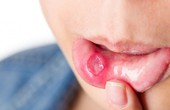 Nhiệt miệng là gì? Biểu hiện và cách chữa bệnh