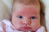 Viêm da cơ địa ở trẻ em: Nguyên nhân, triệu chứng và cách phòng ngừa
