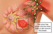 Những điều cần biết về u diệp thể ở vú