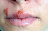 Triệu chứng bệnh giang mai ở miệng và cách điều trị dứt điểm