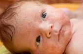 Hướng dẫn các cách phòng tránh viêm da tiếp xúc ở trẻ em