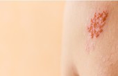Bệnh viêm da tiếp xúc là gì? Nguyên nhân và cách phòng tránh căn bệnh ngoài da thường gặp