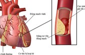 Những nguyên nhân gây bệnh van tim thường gặp