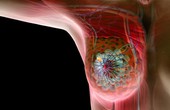 Những điều cần biết về bệnh giãn ống tuyến vú ở phụ nữ