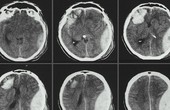Tìm hiểu về bệnh chấn thương sọ não nhẹ