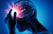 Phình mạch máu não và những biến chứng nguy hiểm