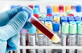 Tìm hiểu về phương pháp xét nghiệm Clo máu