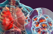 Biến chứng viêm phổi do viêm phế quản: Cách nhận biết và phòng ngừa