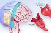 Phình mạch máu não là gì? Cần phát hiện sớm để tránh tử vong