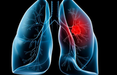 Bị ung thư cổ tử cung di căn phổi: Cơ hội sống sót thực sự không còn?