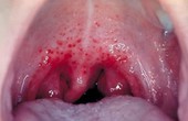 Các thể bệnh lâm sàng của ung thư vòm họng và cách chẩn đoán