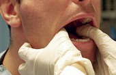 Một số bài tập cải thiện chức năng nhai - nuốt ở bệnh nhân ung thư vòm họng sau điều trị