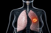 5 loại thực phẩm có hại cho phổi cần chú ý sử dụng đúng cách