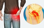 Đau một bên mông là bệnh gì? Cẩn thận với nguy cơ mắc thoát vị đĩa đệm