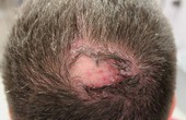 Viêm nang lông da đầu gây rụng tóc: Cách xử lý và phòng ngừa biến chứng