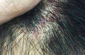 Mức độ nguy hiểm của biến chứng sẹo lồi do viêm nang lông và cách xử lý
