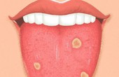 Tự kiểm tra lưỡi tại nhà để phát hiện 8 căn bệnh này