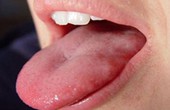 Những điều cần lưu ý khi tái tạo lưỡi do ung thư lưỡi