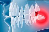 Răng khôn là răng gì? Những điều cần biết về việc nhổ răng khôn