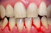 Chảy máu chân răng: Nguyên nhân, dấu hiệu và cách phòng ngừa