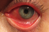 Viêm mống mắt là gì? Bệnh có nguy hiểm không?