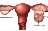 U nang buồng trứng là gì? Nguyên nhân, dấu hiệu, biến chứng và phương pháp điều trị