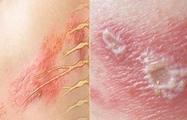 Các bệnh da do virus hay gặp vào mùa nắng nóng