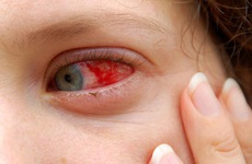 Bác sĩ Viện mắt Hà Nội: Mùa mưa bão tháng 10 - 11 là thời điểm của bệnh đau mắt đỏ!