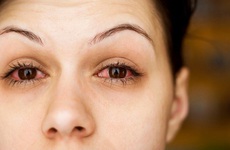 Các vấn đề nhiễm trùng mắt thường gặp trong mùa mưa cần biết