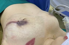 Cô gái trẻ bị lở loét vòng 1 do đến 1 spa nâng ngực: Nâng treo ngực sa trễ cần lưu ý gì?