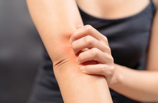 Một số cách giảm ngứa cho vùng da bị nấm da