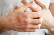 Những yếu tố nào làm tăng nguy cơ bị bệnh nấm da