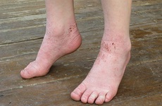 Bệnh về da mùa mưa: Nhiễm khuẩn da và bệnh da do ký sinh trùng