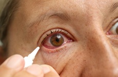 Các biện pháp hỗ trợ điều trị đau mắt đỏ tại nhà giúp giảm bớt các triệu chứng khó chịu
