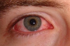 Phụ huynh lưu ý đưa trẻ bị đau mắt đỏ đến bệnh viện ngay khi thấy những dấu hiệu này