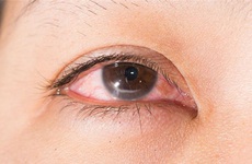 Những biện pháp phòng tránh bệnh đau mắt đỏ khi có dịch  người bệnh cần biết